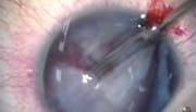 Pediatric Traumatic Cataract