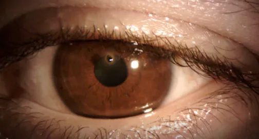 Cornea Foreign Body Removal