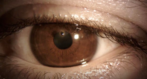 Cornea Foreign Body Removal thumbnail
