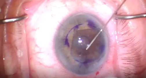 DMEK in Fuchs Endothelial Dystrophy
