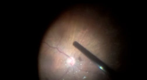 Recurrent Epiretinal Membrane and New Peeling After Brilliant Blue Staining and Sparing the ILM