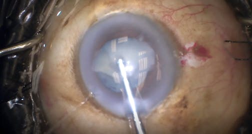 White Cataract and Glaucoma