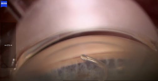 Angle of Approach With OMNI