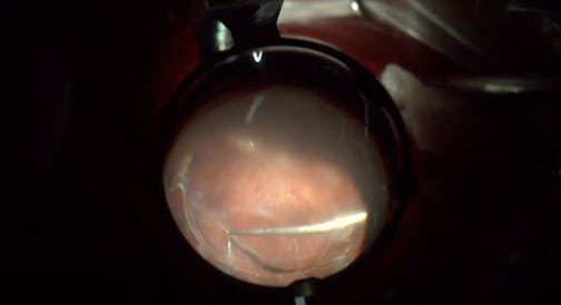 Combined Surgery for Pseudophakic Retinal Detachment