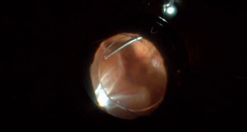 Long-Standing Choroidal Detachment Following Myopic Retinal Detachment Repair