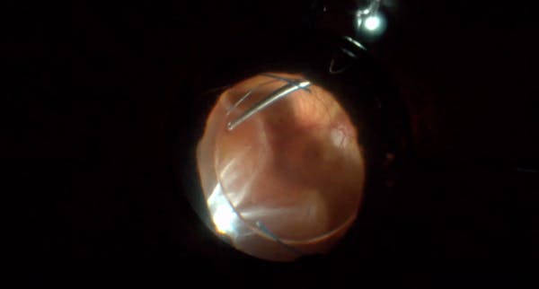 Long-Standing Choroidal Detachment Following Myopic Retinal Detachment Repair thumbnail