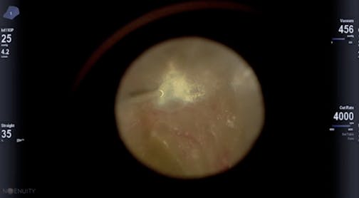 Hybrid 25/27-Gauge Tractional Retinal Detachment