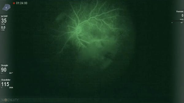 Intraoperative Fluorescein Angiography for Macular Pucker and Vitreomacular Traction thumbnail