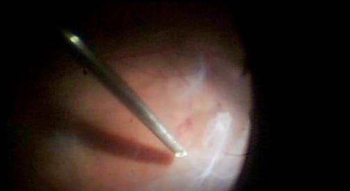 Fibrous Tissue Peel and Broad ILM Stripping for Tractional Retinal Detachment