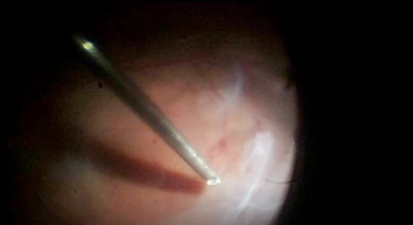 Fibrous Tissue Peel and Broad ILM Stripping for Tractional Retinal Detachment thumbnail