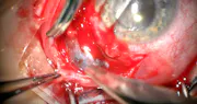 Management of An Extruded Silicone Scleral Buckle