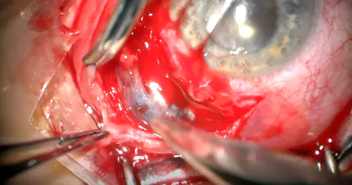 Management of An Extruded Silicone Scleral Buckle
