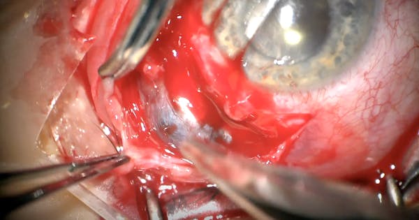 Management of An Extruded Silicone Scleral Buckle thumbnail