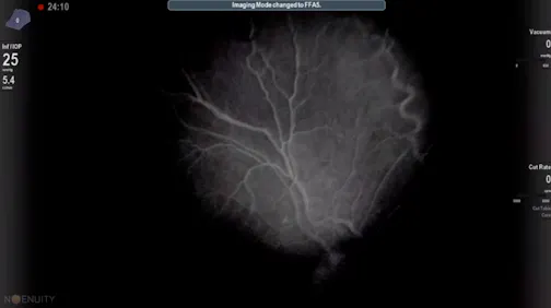 3D Intraoperative Angioscopy