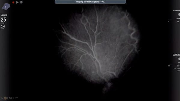 3D Intraoperative Angioscopy thumbnail