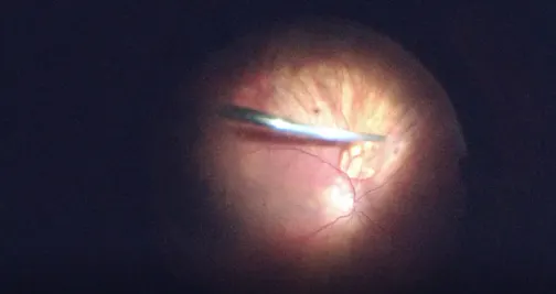 Drainage Retinotomy for Rhegmatogenous Retinal Detachment Repair