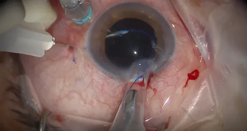 Sutureless Intrascleral Fixation of a Secondary IOL: Modified Yamane Technique
