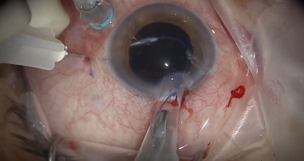 Sutureless Intrascleral Fixation of a Secondary IOL: Modified Yamane Technique thumbnail