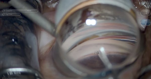SION Goniotomy thumbnail