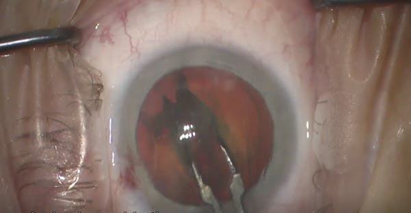 Nucleus Fragmentation With a Prechopper Device thumbnail