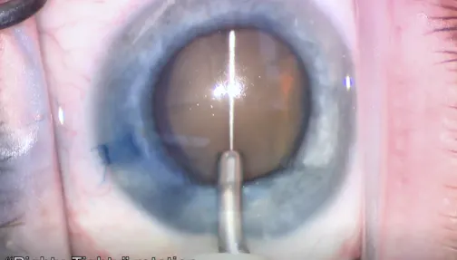 miLoop for Nucleus Fragmentation in Brunescent Cataract