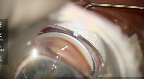 Tailoring Interventional Glaucoma Technology