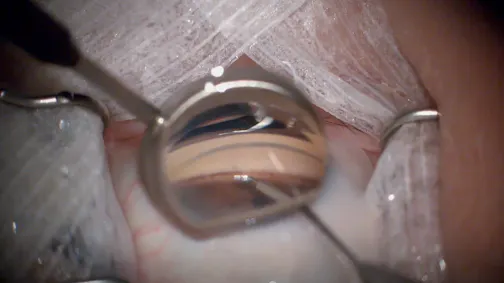SION Bladeless Goniotomy