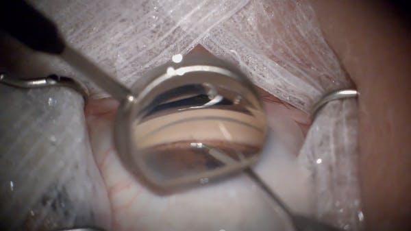 SION Bladeless Goniotomy thumbnail