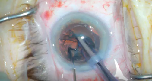 Stop-and-Chop Technique for Moderately Dense Cataract