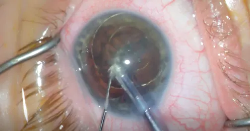 Tilt-and-Tumble Technique for a Soft Cataract