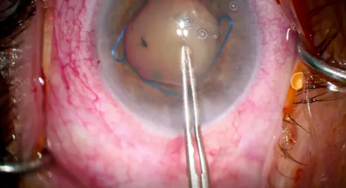 Emulsified Silicone Oil With Cataract and Small Pupil