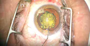 Endolenticular Viscodissection
