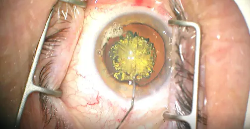 Endolenticular Viscodissection