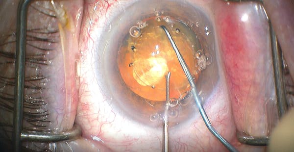 Scott-Beckert Chop thumbnail