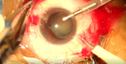 Haptic Tucking Scleral Fixation