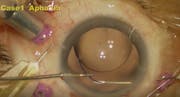 Transconjunctival Intrascleral IOL Fixation With Double Needle Technique