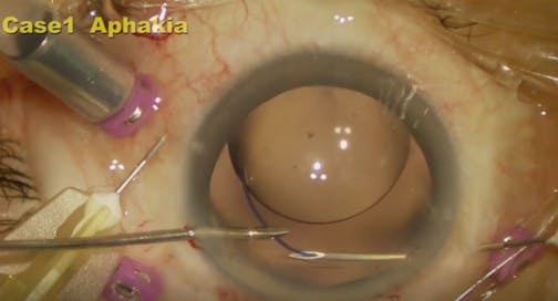 Transconjunctival Intrascleral IOL Fixation With Double Needle Technique