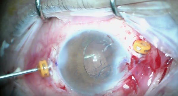 Trocar Assisted thumbnail