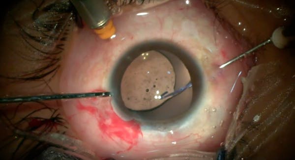 Iris Hook thumbnail