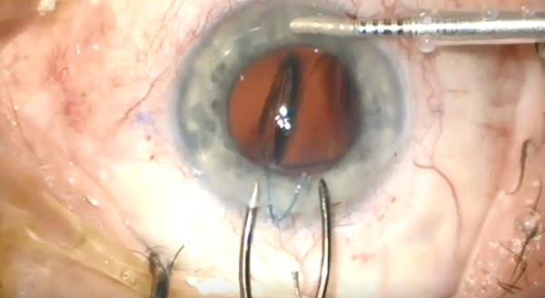 Forceps Needle thumbnail