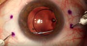 Visconeedling for IOL Capture