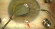 Challenging Case of Intrascleral Haptic Fixation