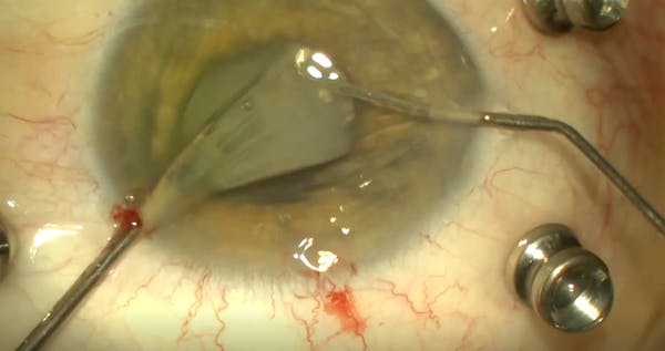 Challenging Case of Intrascleral Haptic Fixation thumbnail