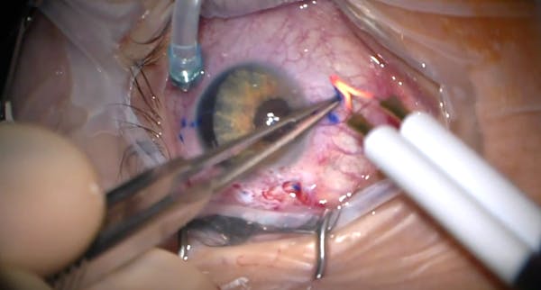 Yamane Plus Artificial Iris thumbnail