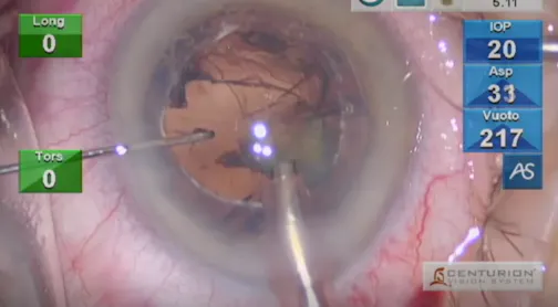 Damaged Posterior Capsule