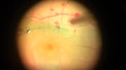 Superior Wide-Base ILM Flap Transposition (SWIFT) Technique for Macular Hole Closure