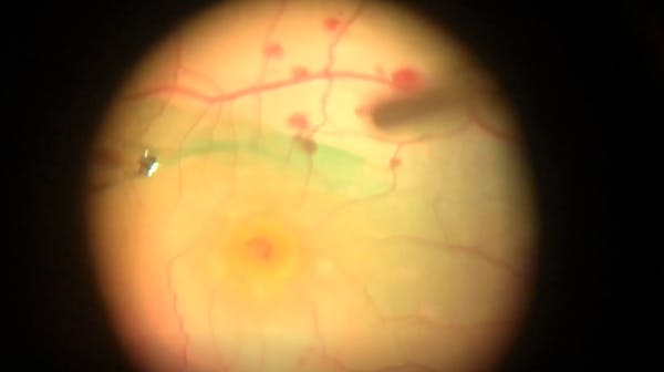 Superior Wide-Base ILM Flap Transposition (SWIFT) Technique for Macular Hole Closure thumbnail