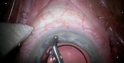 iStent Implantation With Diffuse Blanching