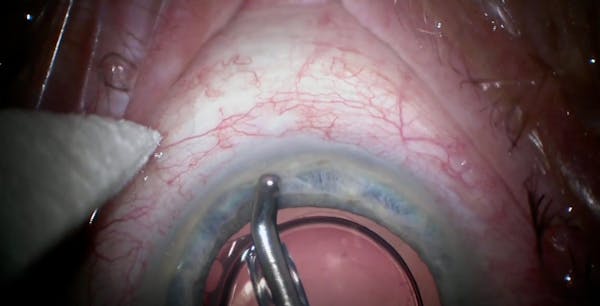 iStent Implantation With Diffuse Blanching thumbnail