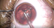 Persistent Fetal Vasculature and Congenital Cataract